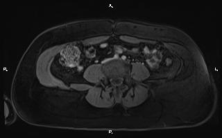 Bilateral adrenal myelolipoma (Radiopaedia 63058-71537 G 74).jpg