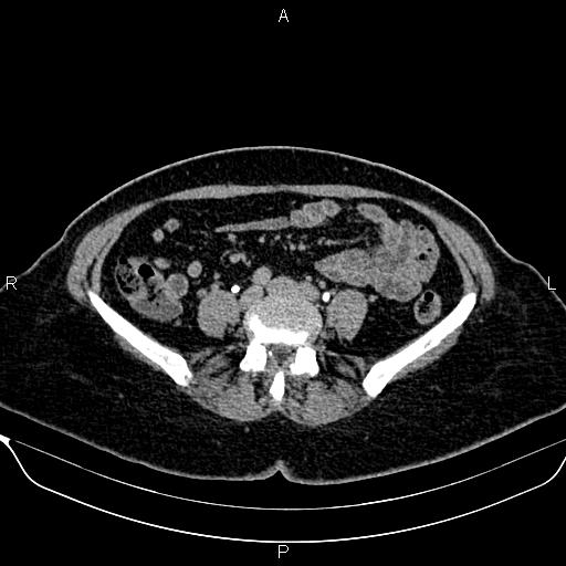 Bilateral benign adrenal adenomas (Radiopaedia 86912-103124 Axial C+ delayed 105).jpg