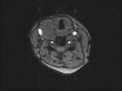 Bilateral carotid body tumors and right glomus jugulare tumor (Radiopaedia 20024-20060 Axial MRA 240).jpg