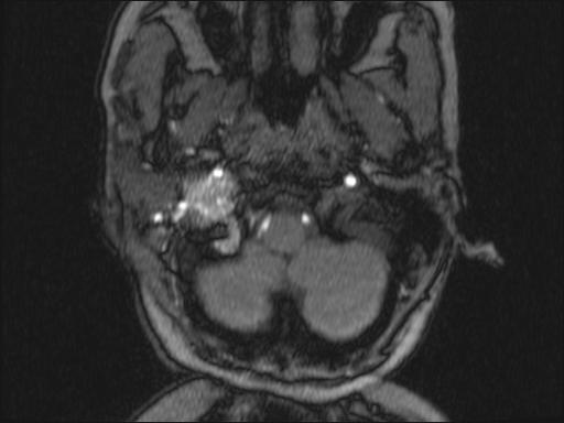 Bilateral carotid body tumors and right glomus jugulare tumor (Radiopaedia 20024-20060 Axial MRA 302).jpg