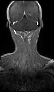 Bilateral carotid body tumors and right glomus jugulare tumor (Radiopaedia 20024-20060 MRA 64).jpg