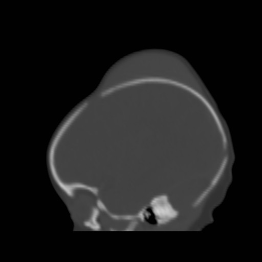 File:Bilateral cephalohematomas and subdural hematomas (Radiopaedia 26778-26929 Sagittal bone window 33).jpg