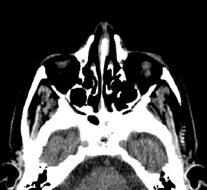 Bilateral ectopia lentis (Radiopaedia 89889-107013 Axial non-contrast 69).jpg