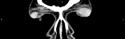 File:Bilateral enlargement of lacrimal glands - sarcoidosis (Radiopaedia 62627-70921 Coronal non-contrast 4).jpg