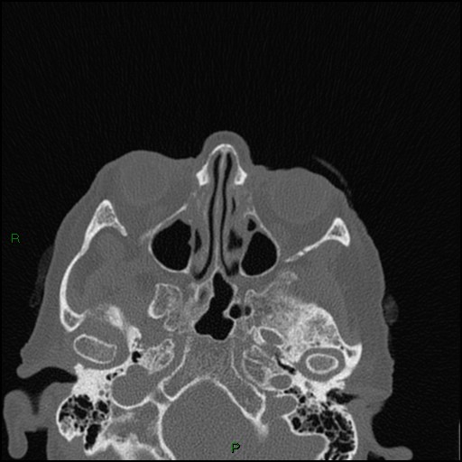File:Bilateral frontal mucoceles (Radiopaedia 82352-96454 Axial bone window 166).jpg
