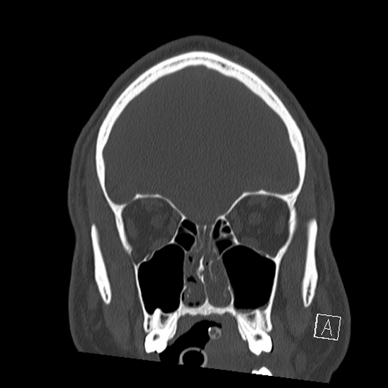 Bilateral occipital condyle fracture (type 2) (Radiopaedia 87675-104089 Coronal bone window 18).jpg