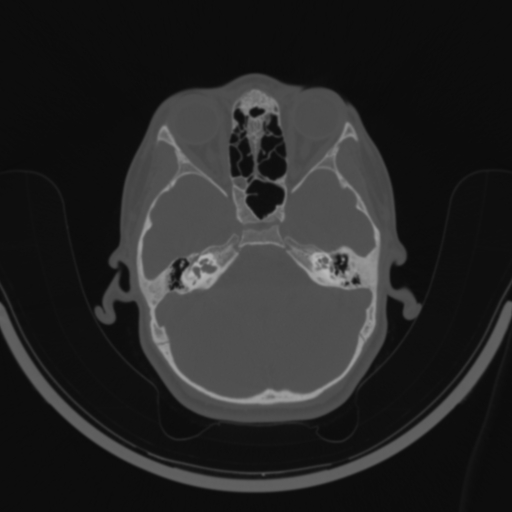 Bilateral otosclerosis (Radiopaedia 57237-64157 C 47).jpg