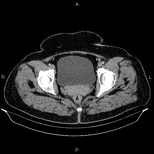 File:Bilateral ovarian dermoid cysts (Radiopaedia 85785-101603 A 101).jpg