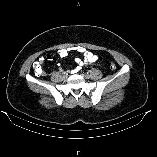 File:Bilateral ovarian dermoid cysts (Radiopaedia 85785-101603 A 77).jpg