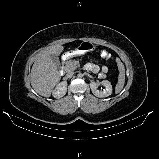 Bilateral ovarian dermoid cysts (Radiopaedia 85785-101603 Axial C+ delayed 23).jpg