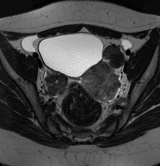 File:Bilateral ovarian fibrothecomas - adolescent (Radiopaedia 86604-102707 Axial T2 21).jpg