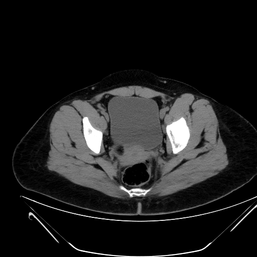 Bilateral ovarian mature cystic teratomas (Radiopaedia 79373-92457 Axial non-contrast 73).jpg