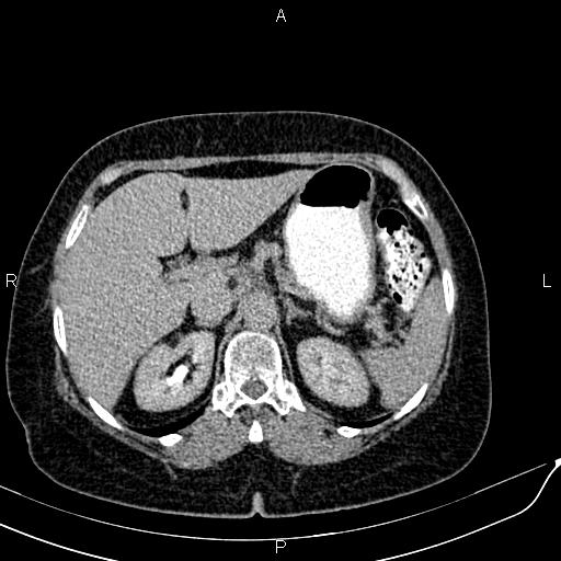 Bilateral ovarian serous cystadenocarcinoma (Radiopaedia 86062-101989 Axial C+ delayed 11).jpg