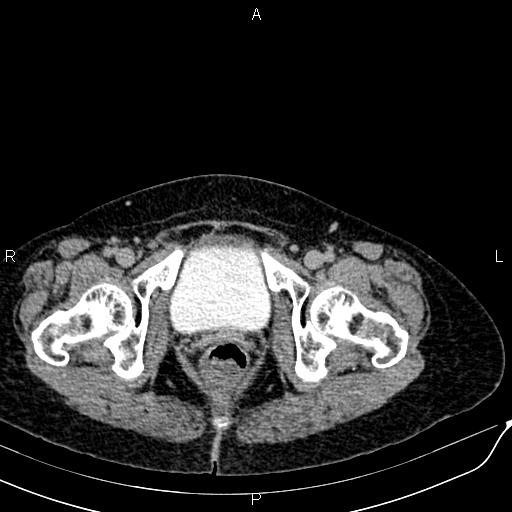 File:Bilateral ovarian serous cystadenocarcinoma (Radiopaedia 86062-101989 Axial C+ delayed 81).jpg