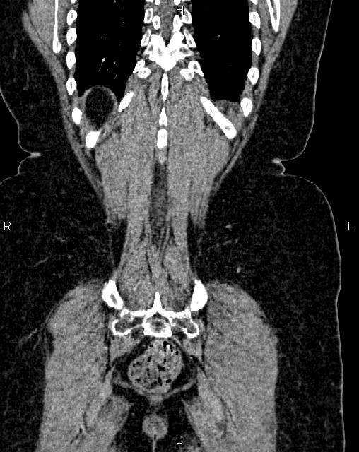 Bilateral ovarian serous cystadenocarcinoma (Radiopaedia 86062-101989 D 49).jpg