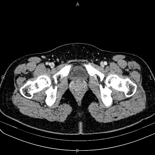 Bilateral ovarian teratoma (Radiopaedia 83131-97503 Axial With contrast 77).jpg