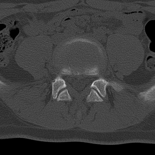 Bilateral pars defect (Radiopaedia 26691-26846 Axial bone window 45).jpg