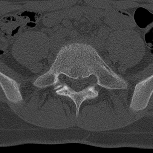 Bilateral pars defect (Radiopaedia 26691-26846 Axial bone window 57).jpg