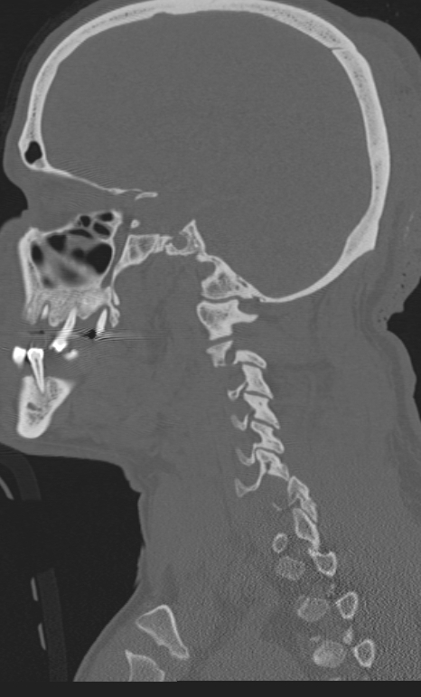 Bilateral perched facet joint (Radiopaedia 63149-71669 Sagittal bone window 1).jpg
