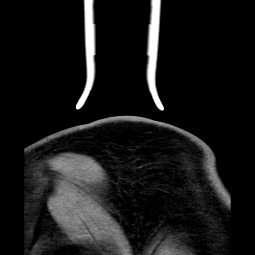 Bilateral peritonsillar abscess (Radiopaedia 85065-100610 Coronal 79).jpg