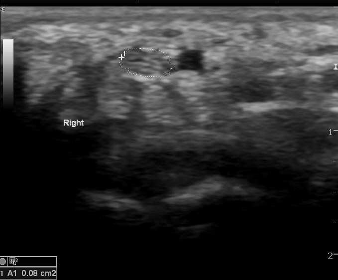 File:Bilateral persistent median artery of the forearm with unilateral bifid median nerve (Radiopaedia 17430-17120 D 1).jpg