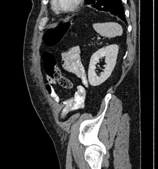 Bilateral rectus sheath hematomas (Radiopaedia 50778-56252 B 63).jpg