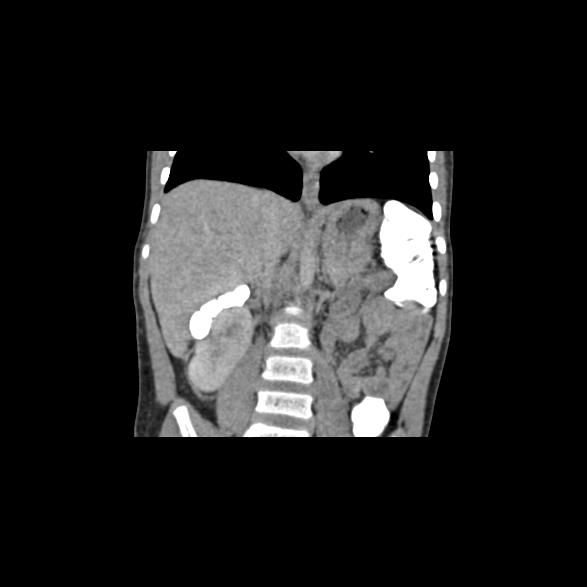 File:Bilateral renal malrotation (Radiopaedia 30901-31606 B 15).jpg