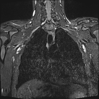 File:Bilateral spinoglenoid notch ganglion cysts (Radiopaedia 29577-30082 Coronal STIR 14).jpg