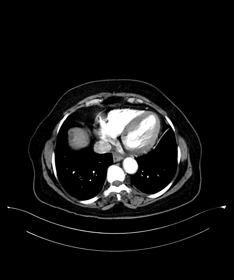 Bilateral sporadic synchronous clear cell renal cell carcinoma (Radiopaedia 85035-100575 B 9).jpg