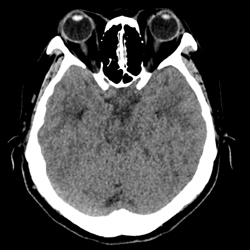 Bilateral subacute subdural hematoma (Radiopaedia 69240-79018 Axial non-contrast 17).jpg