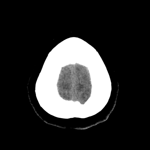 Bilateral subacute subdural hematoma (Radiopaedia 69240-79018 Axial non-contrast 47).jpg