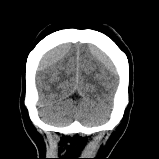 Bilateral subacute subdural hematoma (Radiopaedia 69240-79018 Coronal non-contrast 49).jpg