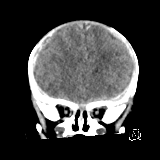File:Bilateral subdural hemorrhage and parietal skull fracture (Radiopaedia 26058-26192 Coronal non-contrast 8).png
