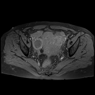 Bilateral tubo-ovarian abscesses (Radiopaedia 58635-65829 Axial T1 fat sat 22).jpg