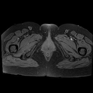 Bilateral tubo-ovarian abscesses (Radiopaedia 58635-65829 Axial T1 fat sat 48).jpg