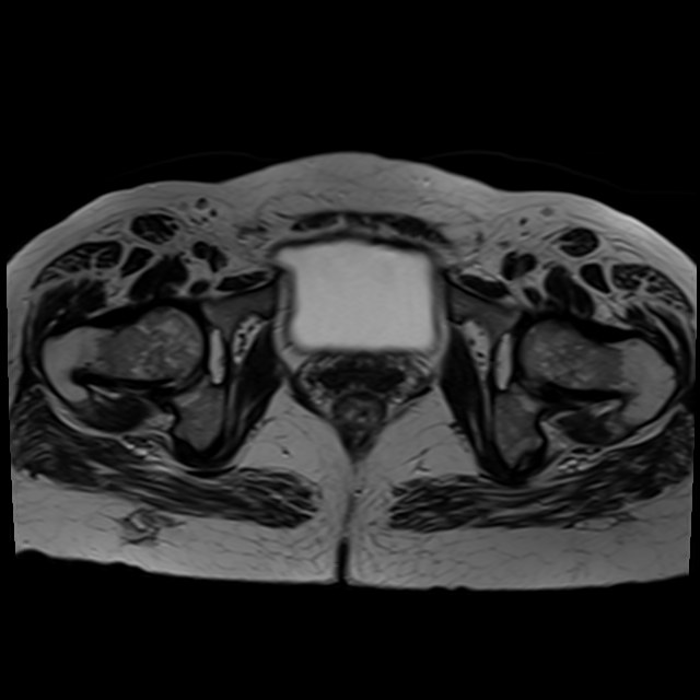 Bilateral tubo-ovarian abscesses (Radiopaedia 58635-65829 Axial T2 38).jpg