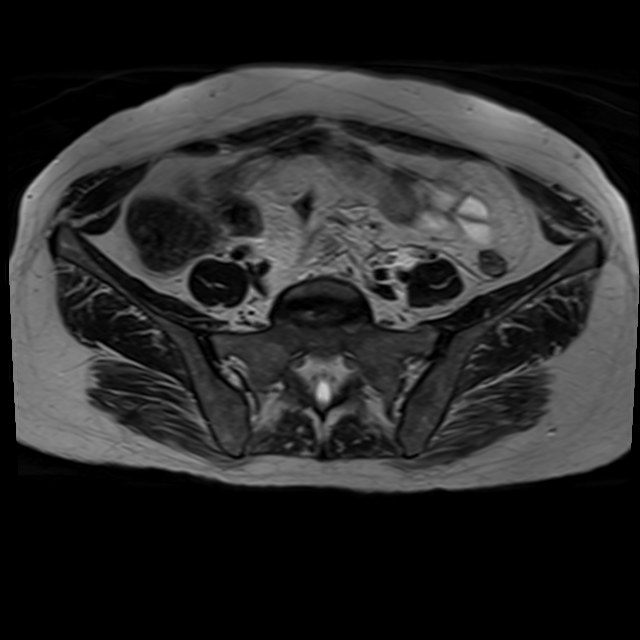 Bilateral tubo-ovarian abscesses (Radiopaedia 58635-65829 Axial T2 6).jpg