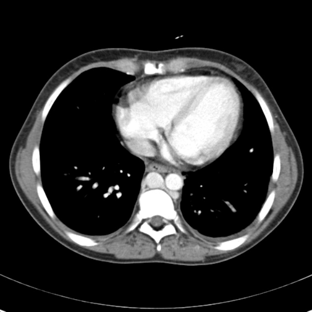 Biliary necrosis - liver transplant (Radiopaedia 21876-21846 B 2).jpg