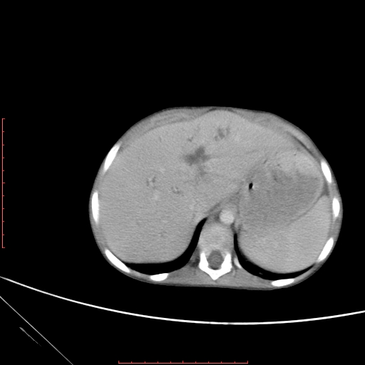 Biliary tract embryonal rhabdomyosarcoma (Radiopaedia 51815-57648 A 13).jpg