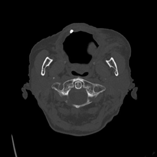 Biparietal osteodystrophy (Radiopaedia 46109-50463 bone window 4).jpg
