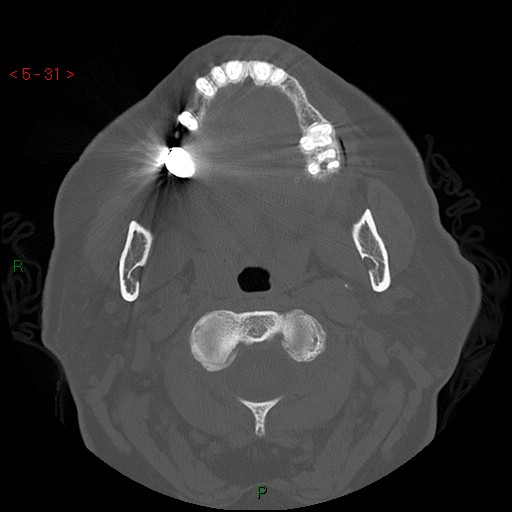 Bisphosphonate-related osteonecrosis of the jaw (Radiopaedia 54147-60329 Axial bone window 25).jpg