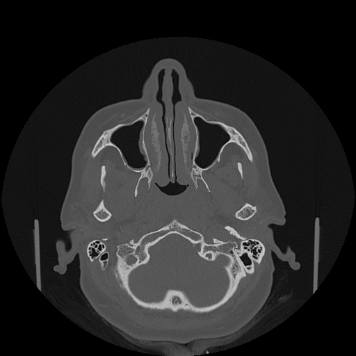 File:Bisphosphonate-related osteonecrosis of the jaw (Radiopaedia 71324-81642 Axial bone window 136).jpg