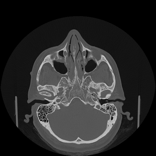 File:Bisphosphonate-related osteonecrosis of the jaw (Radiopaedia 71324-81642 Axial bone window 156).jpg