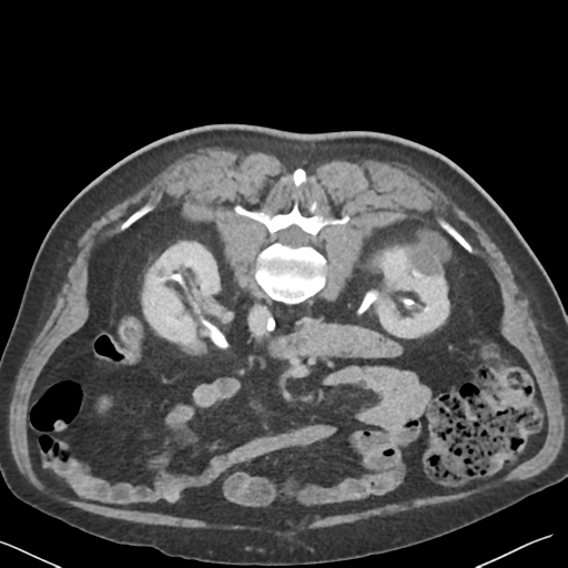 File:Bladder papillary urothelial carcinoma (Radiopaedia 48119-52951 Axial C+ delayed 21).png