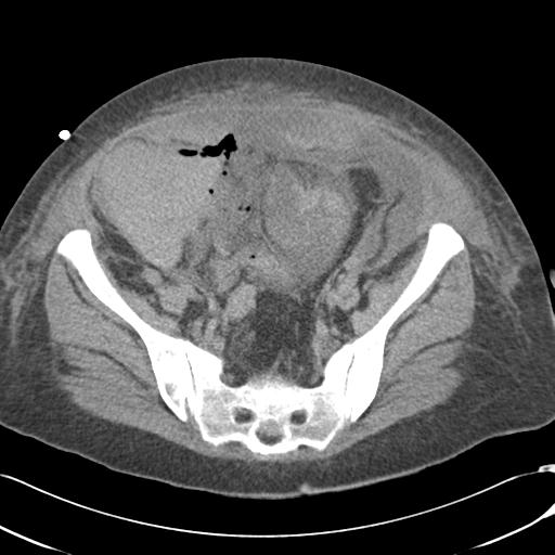 File:Bladder rupture post renal biopsy (Radiopaedia 30863-31572 Axial non-contrast 67).jpg