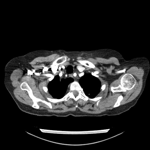 File:Bladder tumor detected on trauma CT (Radiopaedia 51809-57609 A 16).jpg