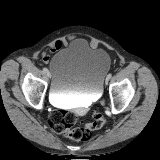 Bladder tumor detected on trauma CT (Radiopaedia 51809-57609 C 123).jpg