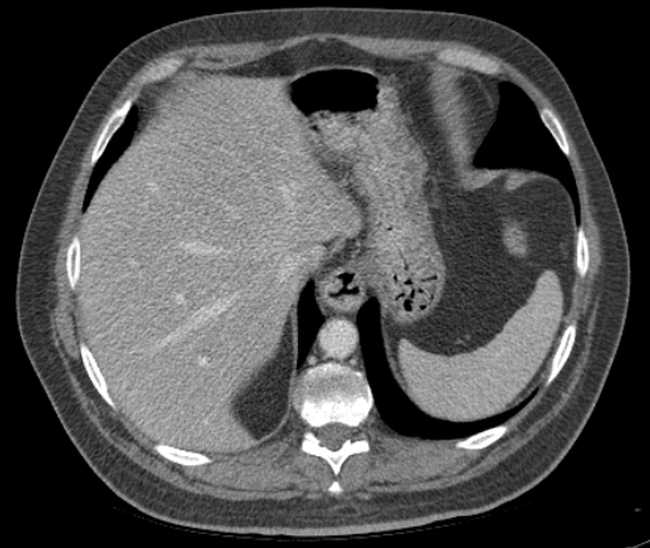 File:Bleeding duodenal ulcer and adenomyomatosis of gallbladder (Radiopaedia 61834-69861 A 19).jpg