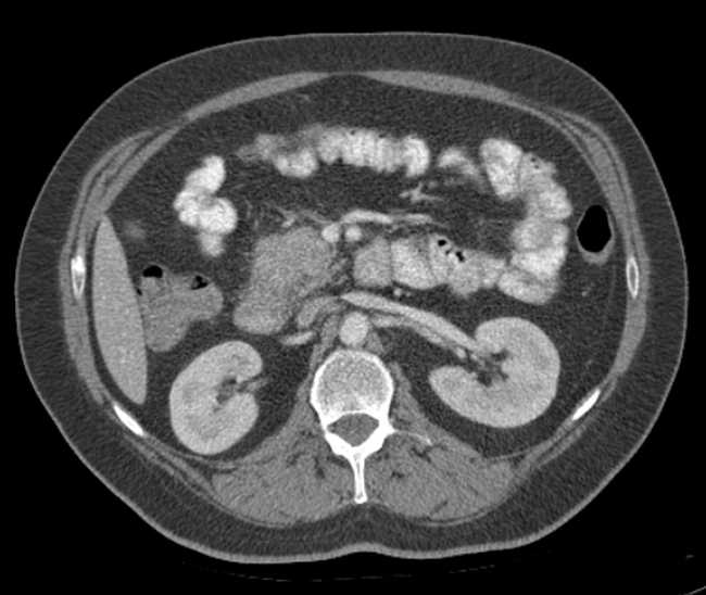 File:Bleeding duodenal ulcer and adenomyomatosis of gallbladder (Radiopaedia 61834-69861 A 49).jpg