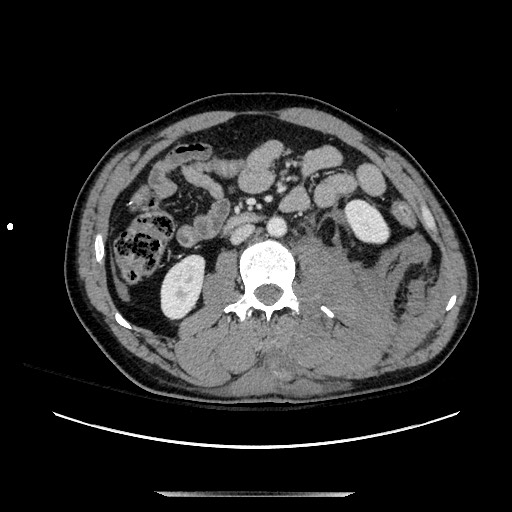 Blunt abdominal trauma with solid organ and musculoskelatal injury with active extravasation (Radiopaedia 68364-77895 A 71).jpg